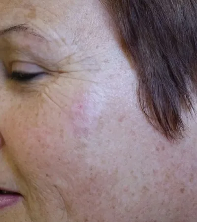 pigmentstörung gesicht