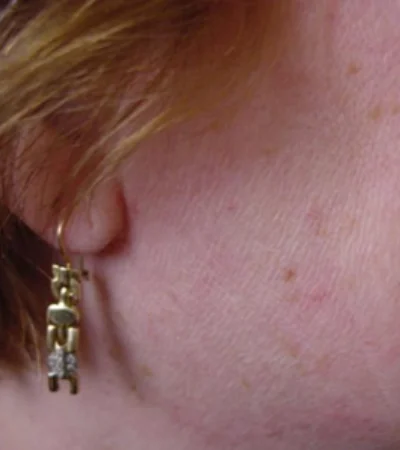 seborrohische keratose