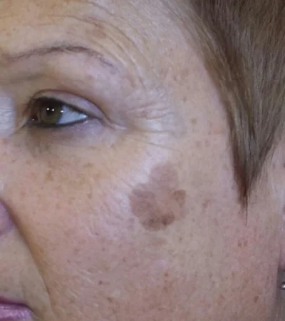 pigmentstörung gesicht