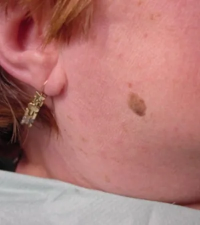 seborrohische keratose